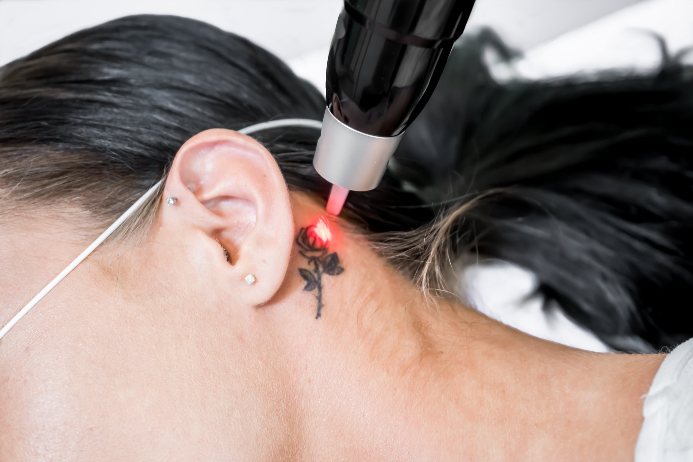 Laser tattoo removal treatment session on patient, using picosecond technology, to break down tattoo ink into smaller particles. At a beauty and skincare clinic for aesthetic lasers.